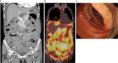 Case Report: Concurrent Occurrence of Abdominal Double Expressor Lymphoma and Jejunum Follicular Lymphoma